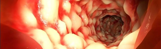 Morbo di Crohn, tutte le informazioni sui sintomi, le cause e la diagnosi della malattia